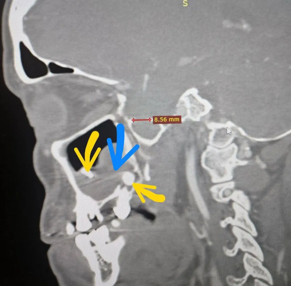 Chronic sinusitis