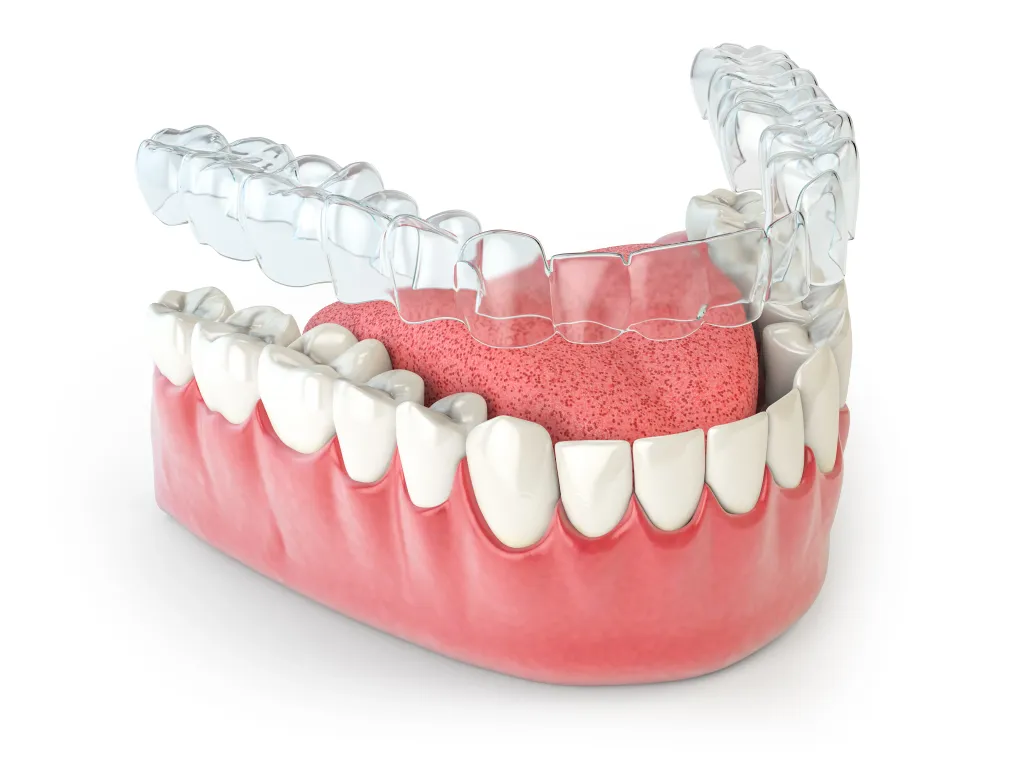 Expansion and alignment of the lower dentition with aligners