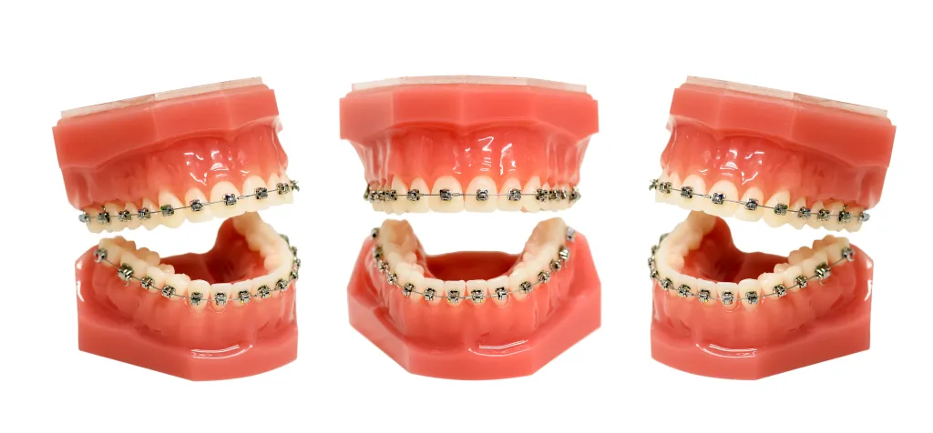 Выравнивание зубов на брекет-системе