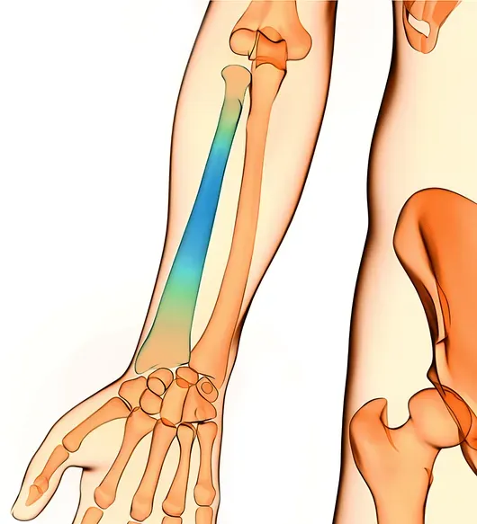 Radius fracture