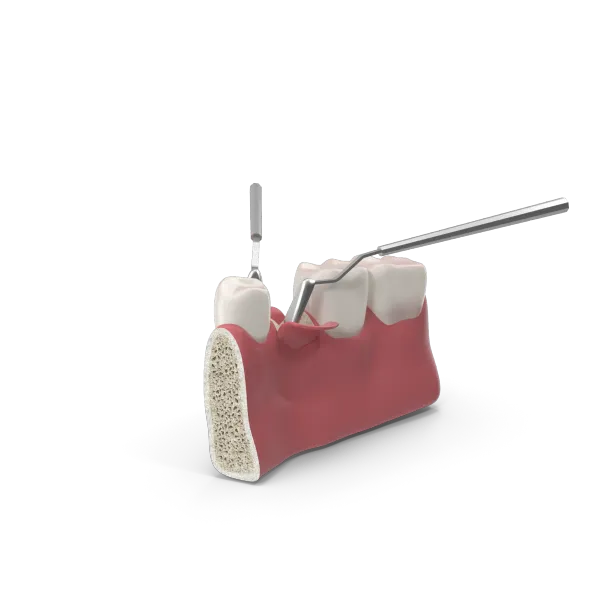 Atraumatic removal of wisdom teeth