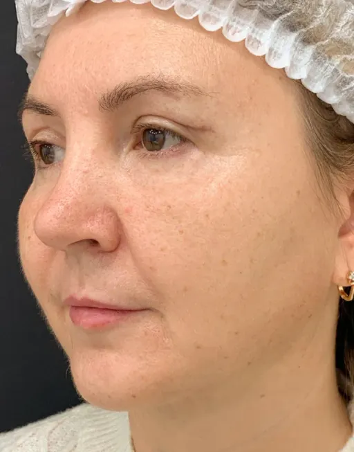 Blefaroplasty