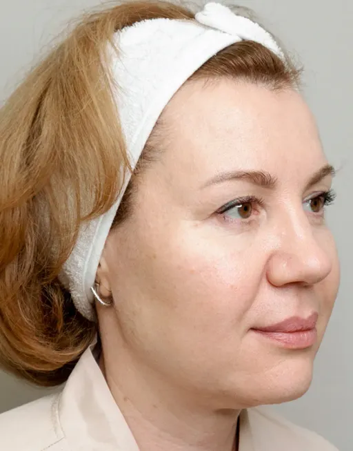 SMAS-лифтинг Utims Hifu A3