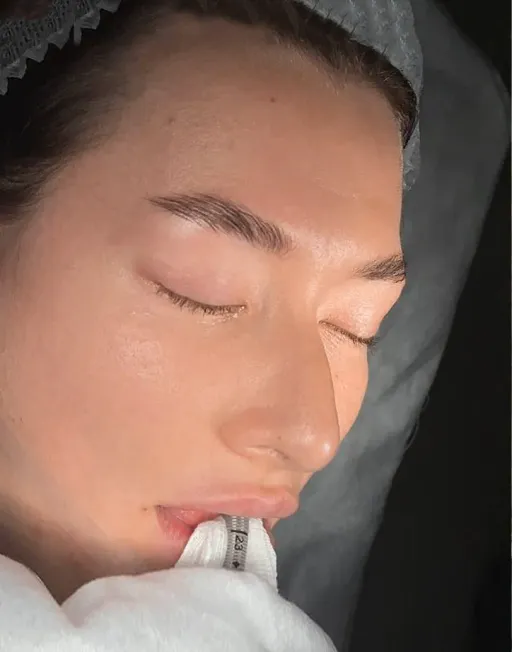 Rhinoseptoplasty