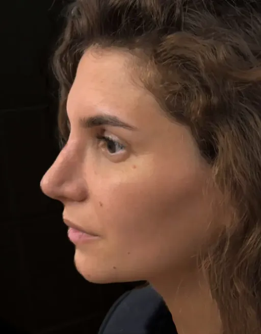 Rhinoseptoplasty