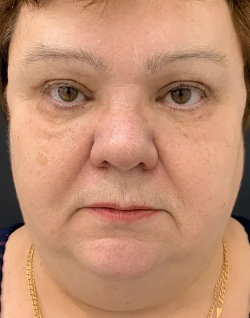 Blefaroplasty