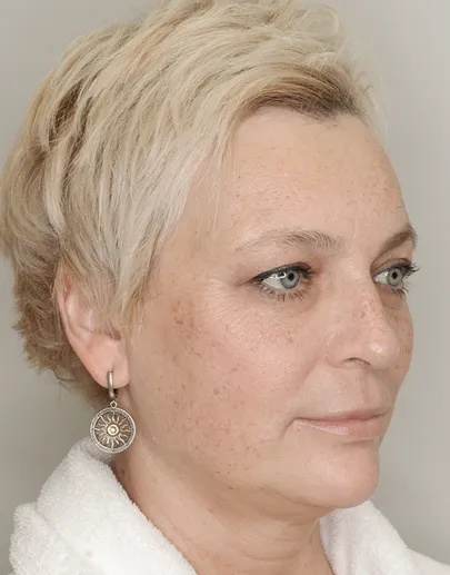 Пилинг, Фототерапия Lumecca IPL