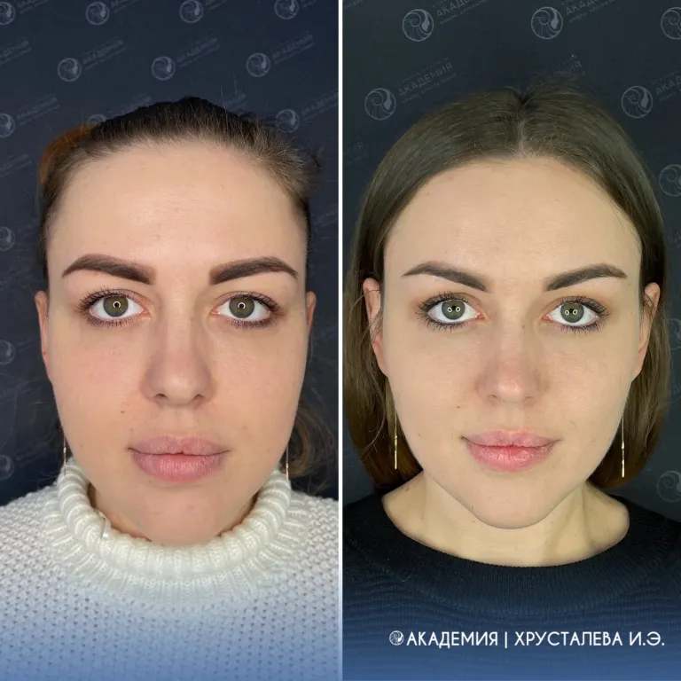 Бьютификация лица Фотографии сделаны до и через 5 месяцев после операции. Анастасии 25 лет. Она обратилась со следующими жалобами: выраженные борозды на нижних веках, излишняя толщина щек, опушенные хвосты бровей и наружных углов глазных щелей.