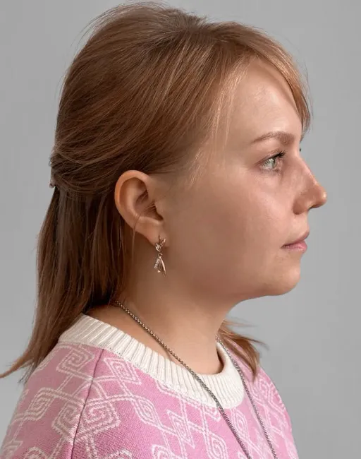 Rhinoseptoplasty