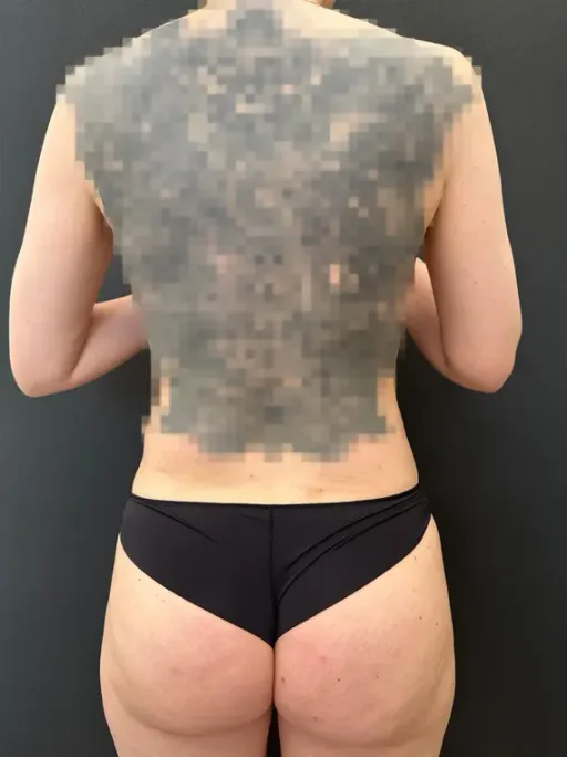 Ultrasonic liposuction ULFIT-TERAPY