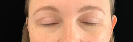 Upper blepharoplasty