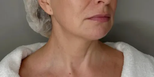 7D-rejuvenation Thermolifting Oligio