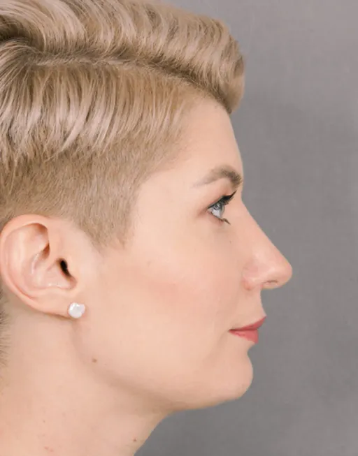 Rhinoplasty