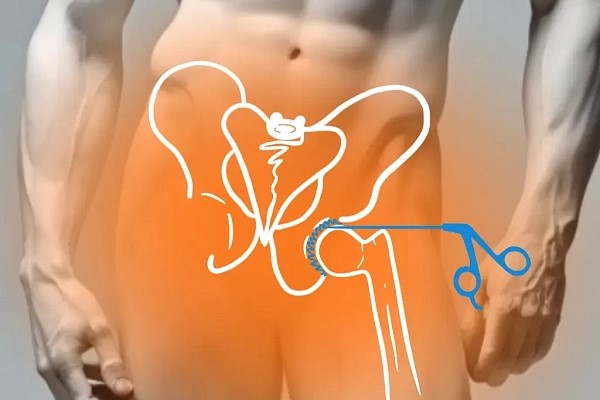 ARS-синдром (энтезопатия приводящих мышц бедра)