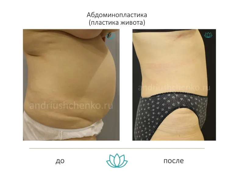 Abdominoplasty (tummy tuck) - our results