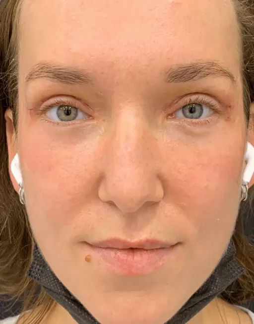Blefaroplasty