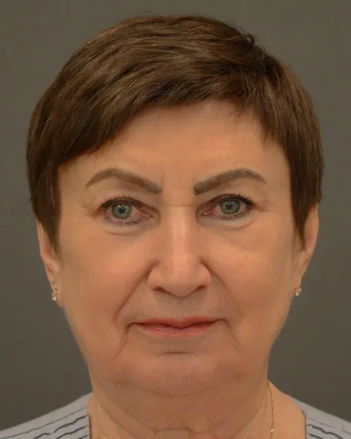 Endoscopic facelift
