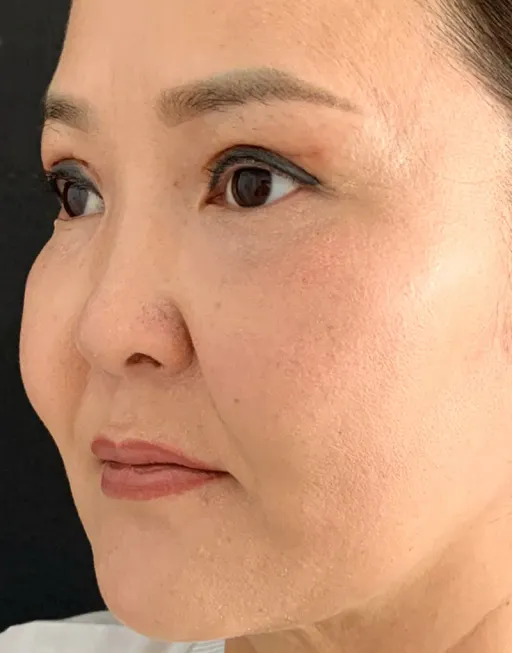 Blefaroplasty