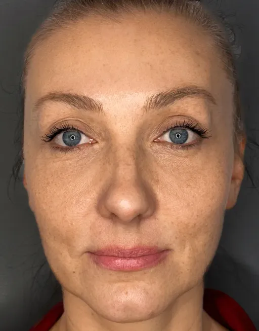 Endoscopic facelift