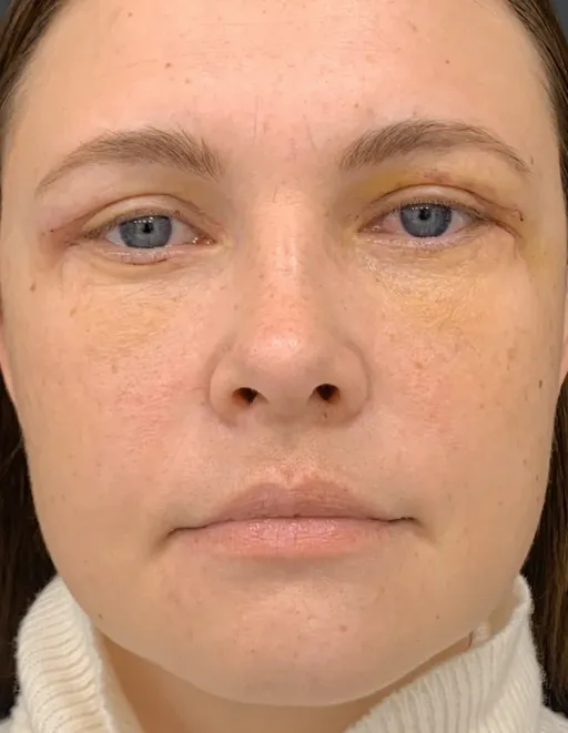 Blefaroplasty