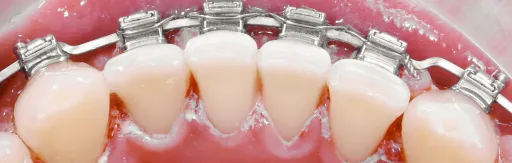 Professional oral hygiene