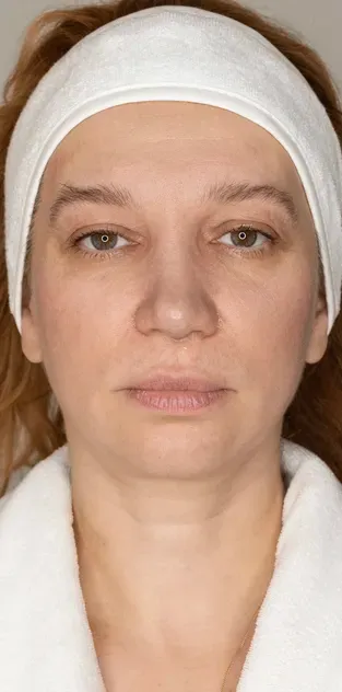 7D-rejuvenation Thermolifting Oligio