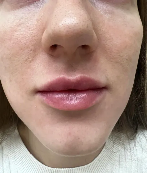 lip contouring