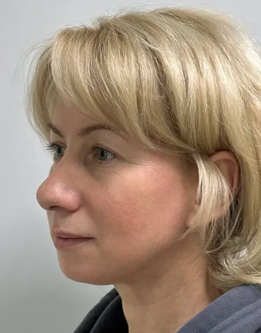 Rhinoseptoplasty