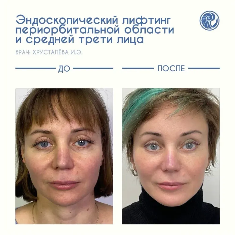 Результат комплексной омолаживающей и гармонизирующей хирургии лица🔝 Фотографии сделаны до и через 1 год после операции.