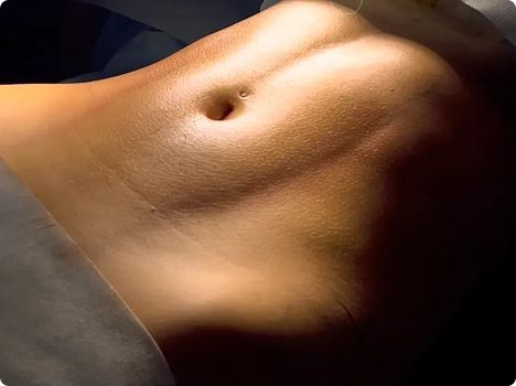Diastasis of the rectus muscles