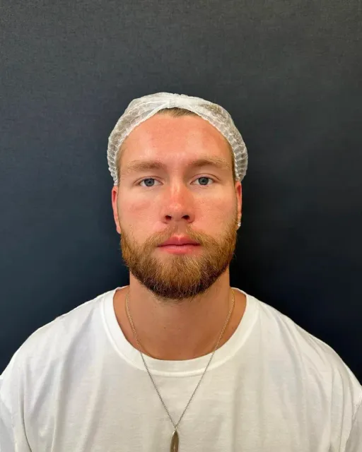 Otoplasty