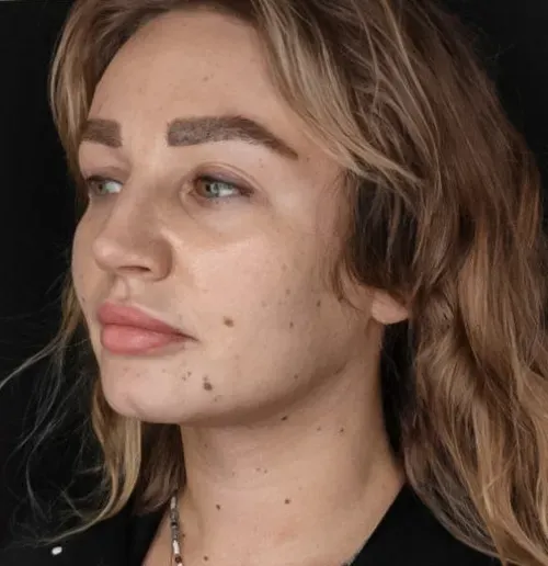Chin liposuction