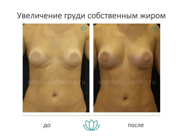 Breast augmentation with own fat - our results