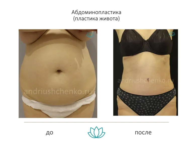 Abdominoplasty (tummy tuck) - our results