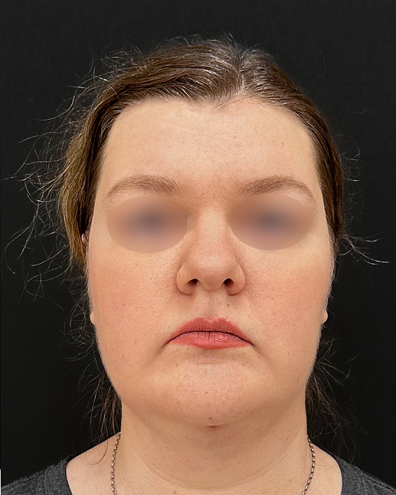  Face liposuction