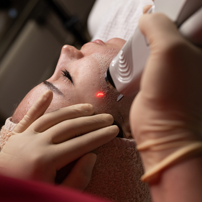 Консультация перед программой шлифовки растяжек, рубцов и постакне