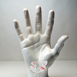 Treatment of fractures of the wrist bones