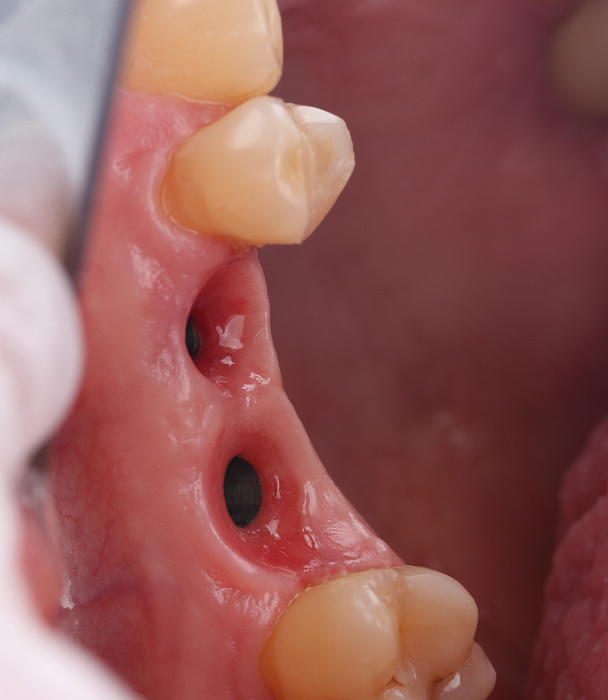 Установка имплантов