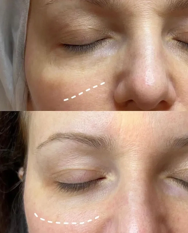 When the patient is not ready for surgical methods (plastic surgery), a cosmetologist takes over the job.