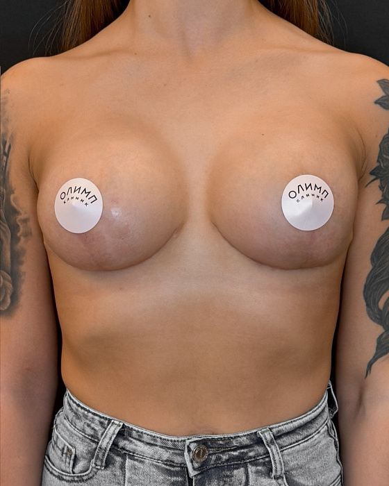 Breast lift (mastopexy) with breast endoprosthetics