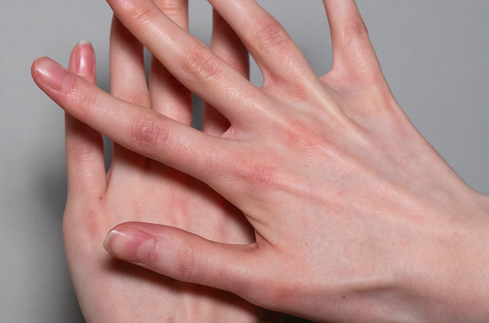 Плазмотерапия