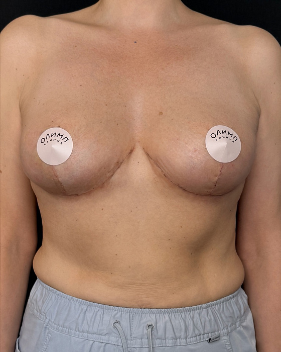 Breast lift (mastopexy)