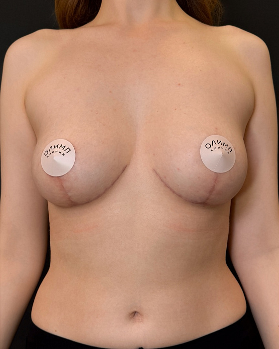 Breast lift (mastopexy)