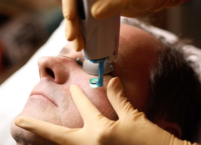 Процедура Лечение дефектов кожи Vbeam в Москве