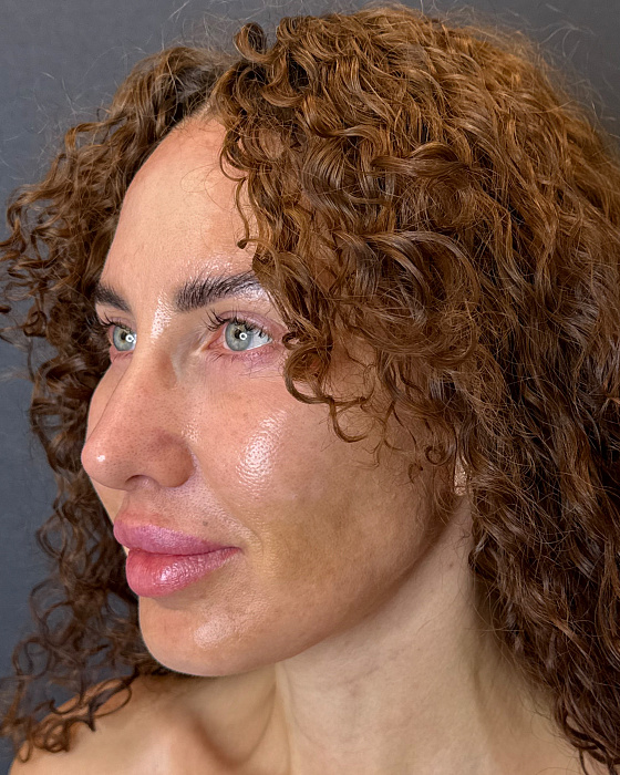 Facelifting