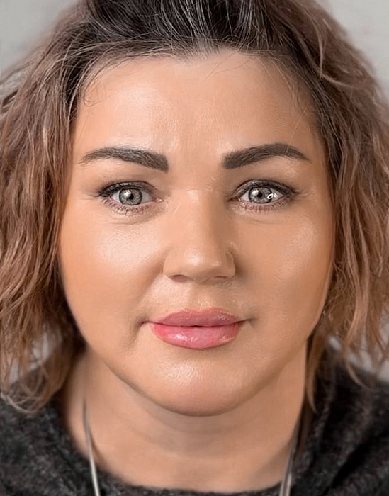 Эндоскопическая подтяжка лба, Верхняя блефаропластика, Эндоскопическая суспензия средней трети лица c расширенной отслойкой DMAS, Платизмопластика