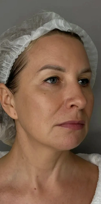 7D-rejuvenation Thermolifting Oligio
