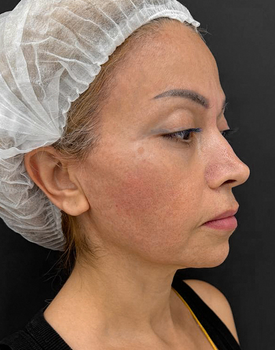 SMAS-лифтинг Ultraformer,  Контурная пластика лица филлером Radiesse