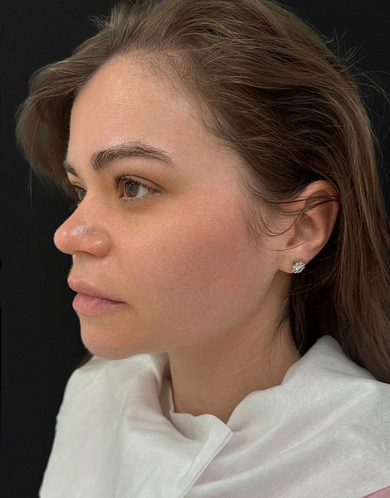 SMAS-лифтинг Ultraformer,  Контурная пластика лица филлером Radiesse