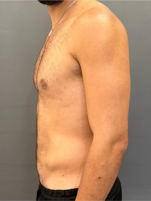 Stomach liposuction